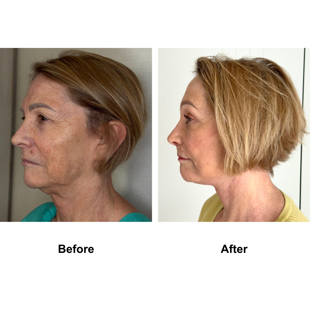 Jocelyn had Revision FFNL + Endo brow lift + Lip lift  with Dr. Ring (2)