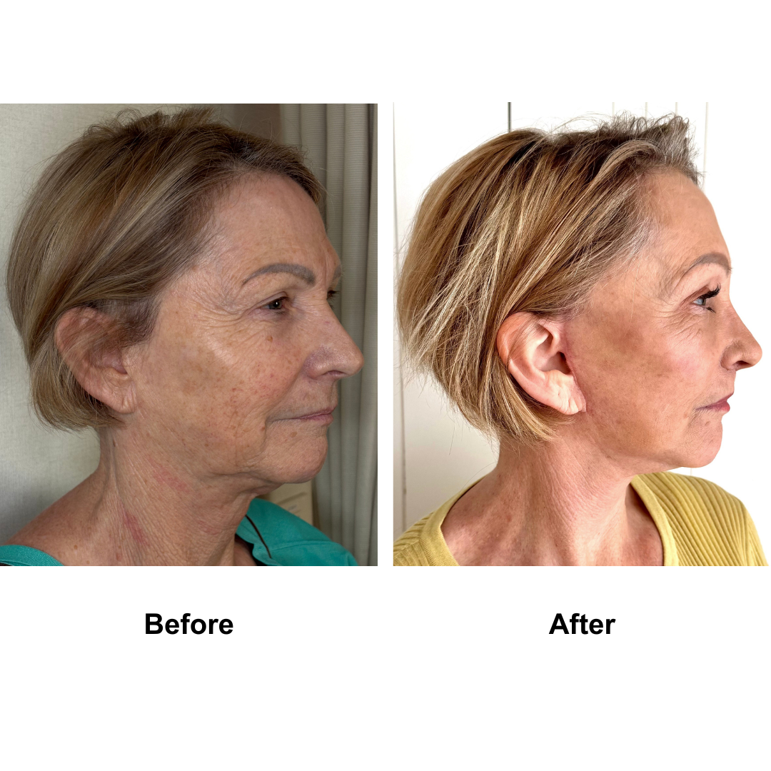 Jocelyn had Revision FFNL + Endo brow lift + Lip lift  with Dr. Ring (3)