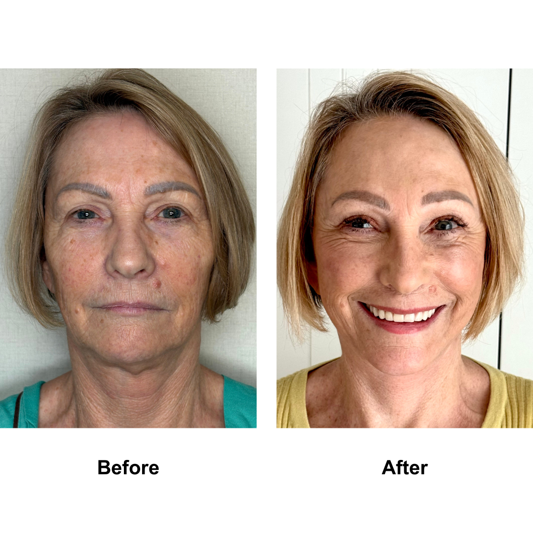 Jocelyn had Revision FFNL + Endo brow lift + Lip lift  with Dr. Ring