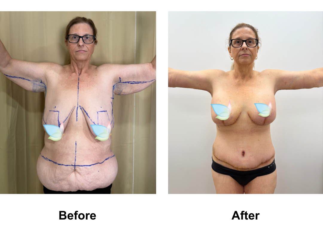 Jodie had BABL(225 M+) + SL + AL + Upper back lift + ExTT + VASER lipo on love handles + Mons lift with Dr. Weerachai