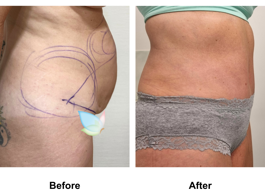 Jodie had Extt + lipo2 with Dr. Eddy (1)