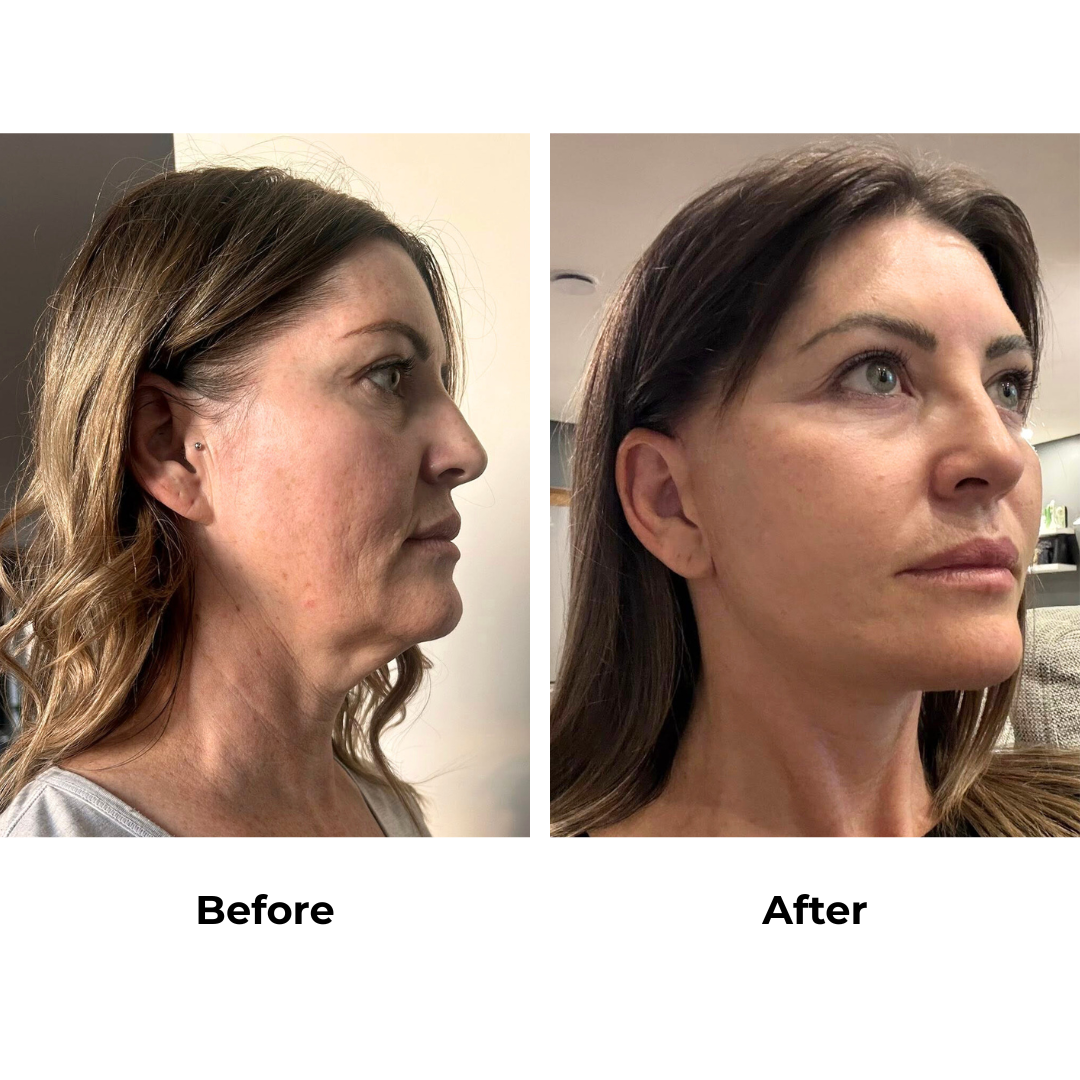 Jodie had MFNL with Dr. NJ - 3 weeks (3)