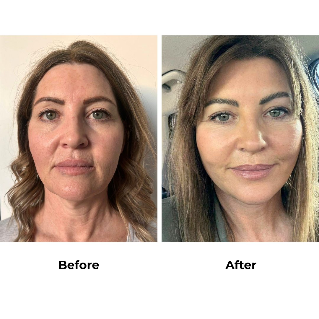 Jodie had MFNL with Dr. NJ - 6 weeks