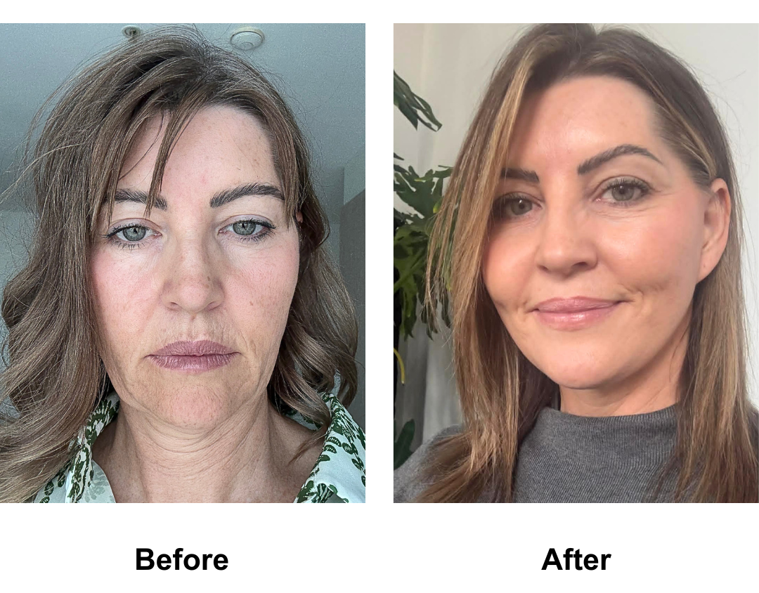 Jodie had Mid-Facelift with Neck Lift with Dr. NJ - 11 months   (1)