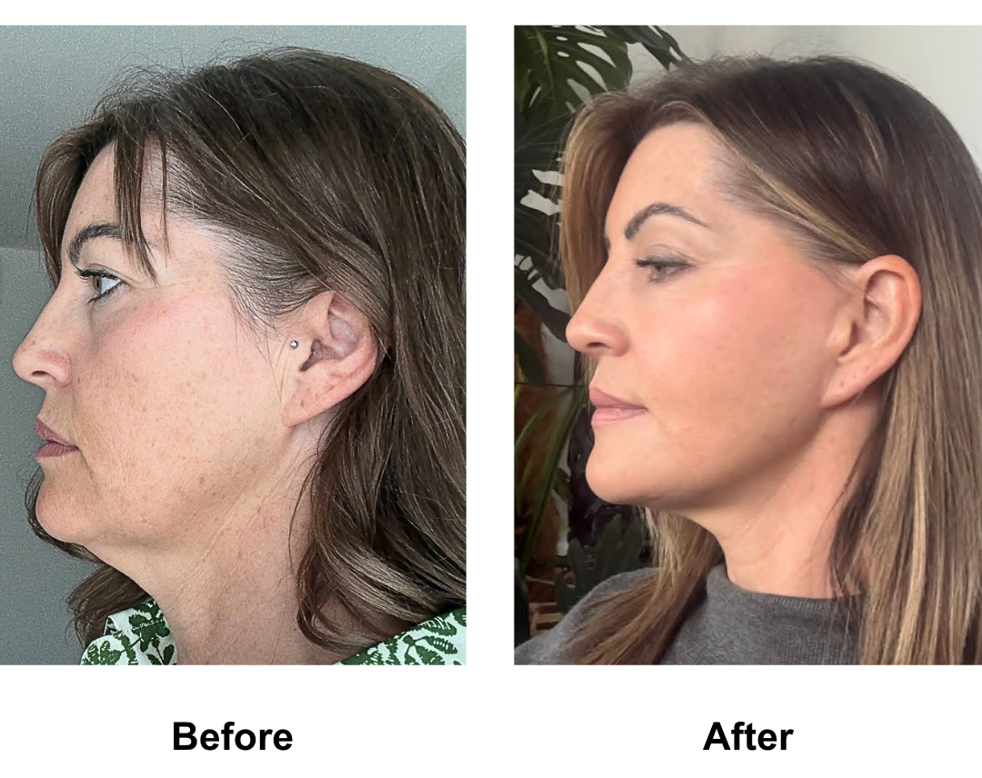 Jodie had Mid-Facelift with Neck Lift with Dr. NJ - 11 months