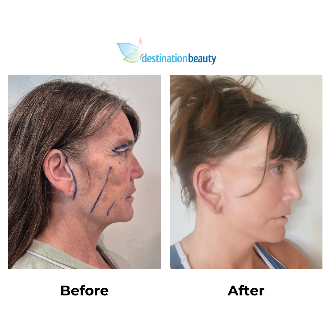 Jody had facelift with Dr. NJ (2)