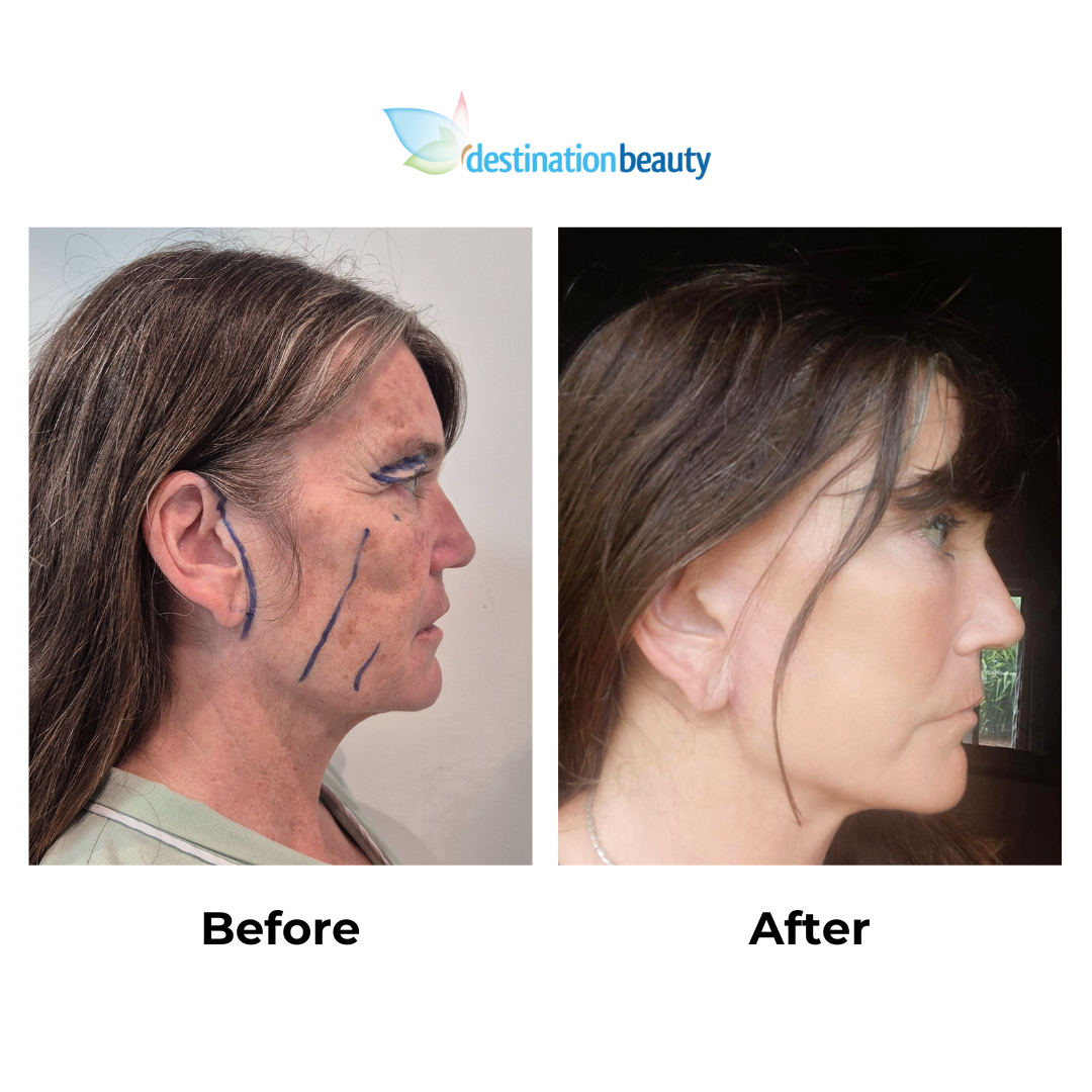 Jody had facelift with Dr. NJ - 10 weeks PO