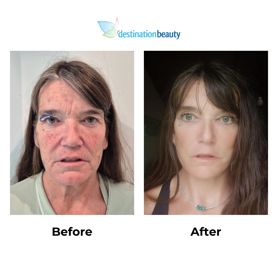 Jody had facelift with Dr. NJ - 10 weeks post-op