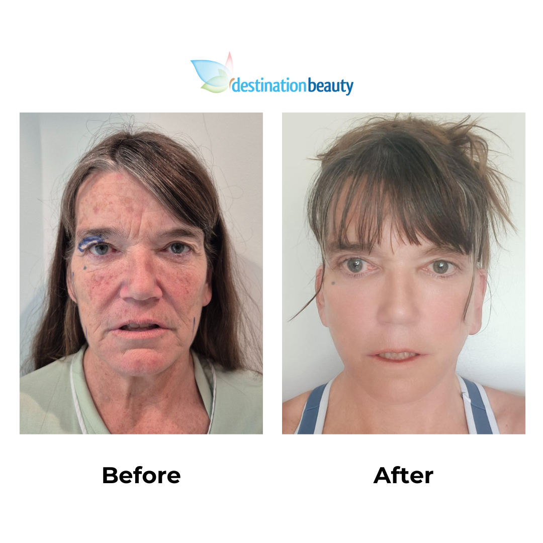 Jody had facelift with Dr. NJ