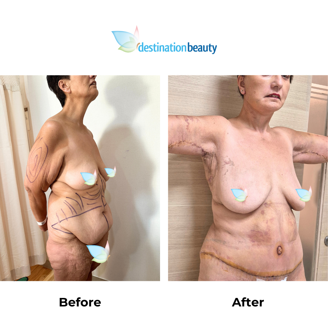 Juanita had arm lift, tummy tuck, and liposuction in Thailand (2)