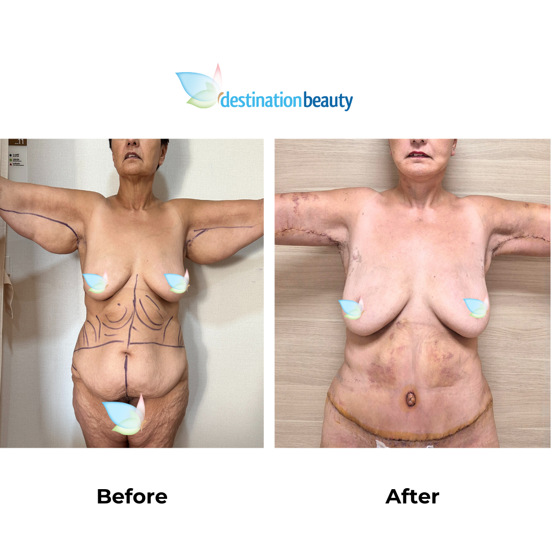 Juanita had arm lift, tummy tuck, and liposuction in Thailand-1