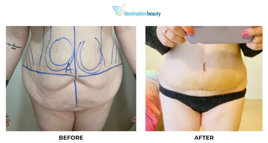 Julia extended tummy tuck and liposuction