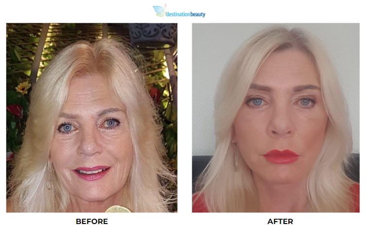 Julia before and after facelift