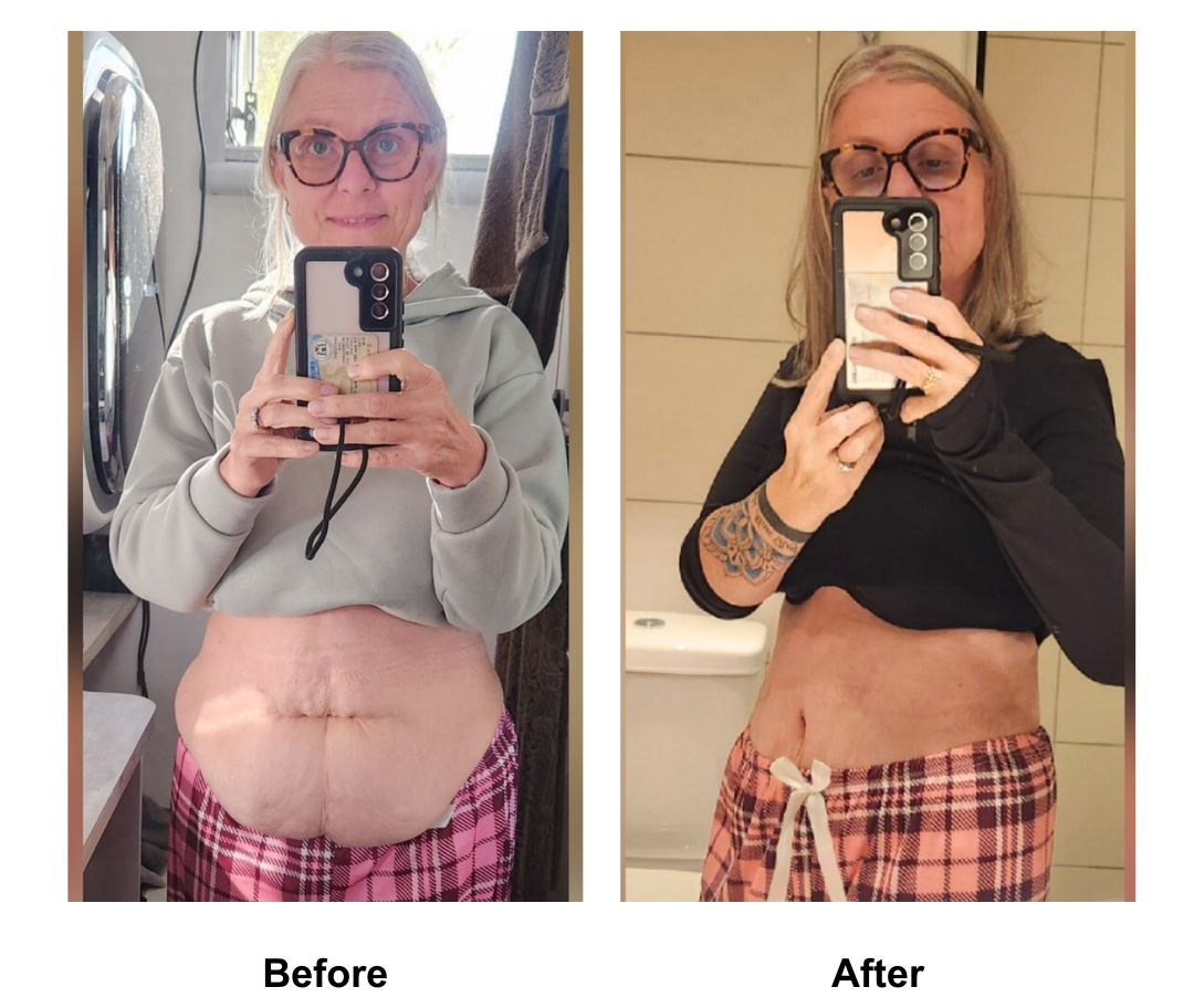 Julia had ExTT + VASER lipo 2 + Mons lift with Dr. Kasemsak