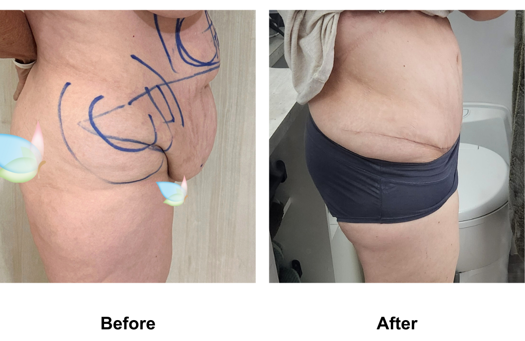 Julia had ExTT + VASER lipo_ 2 + Mons lift with Dr. Kasemsak (3)