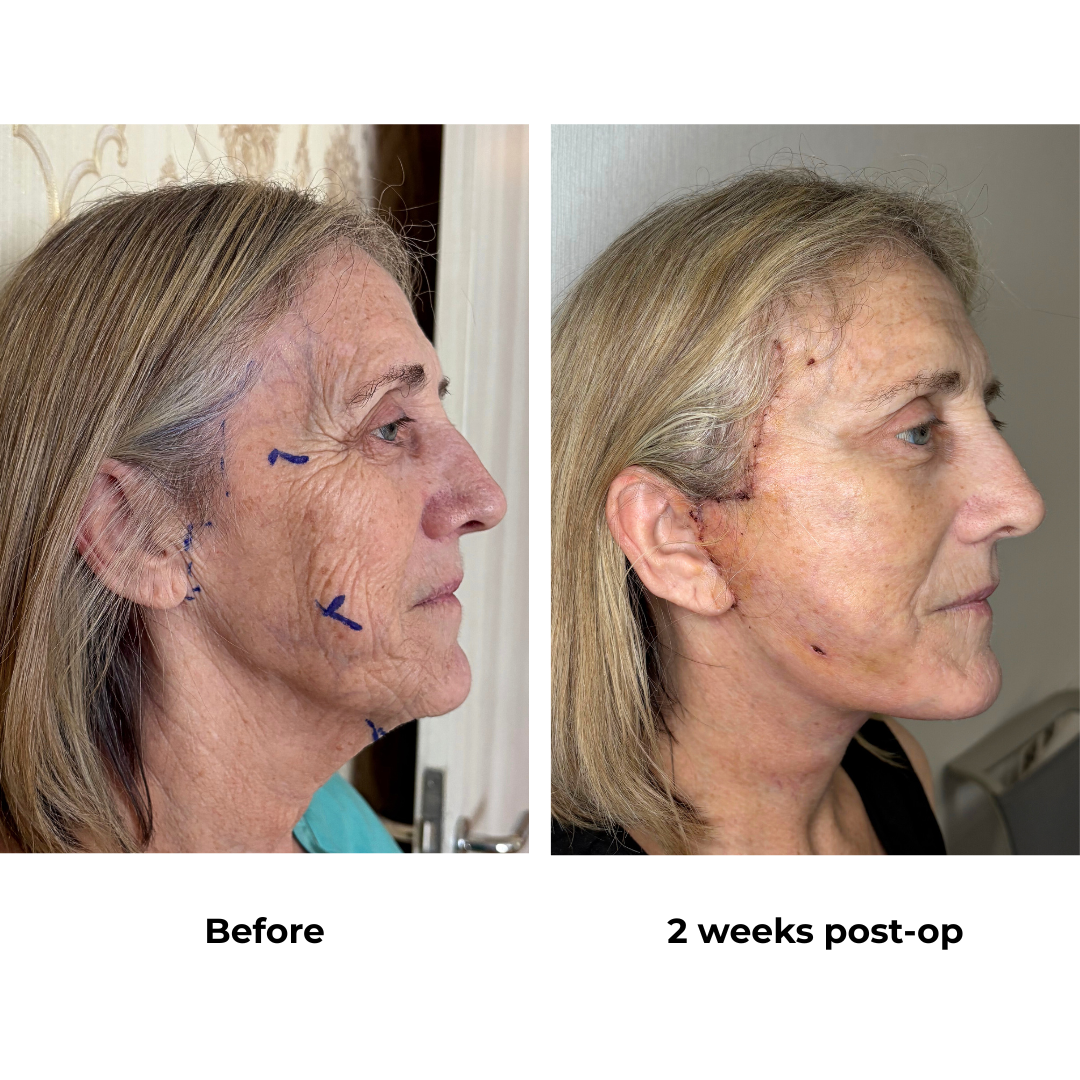 Julie FFNL + Platysmaplasty with Dr. Ring