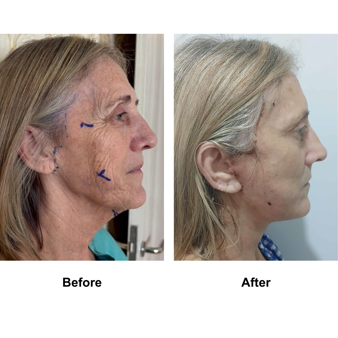 Julie had FFNL + Platysmaplasty with Dr. Ring (2)