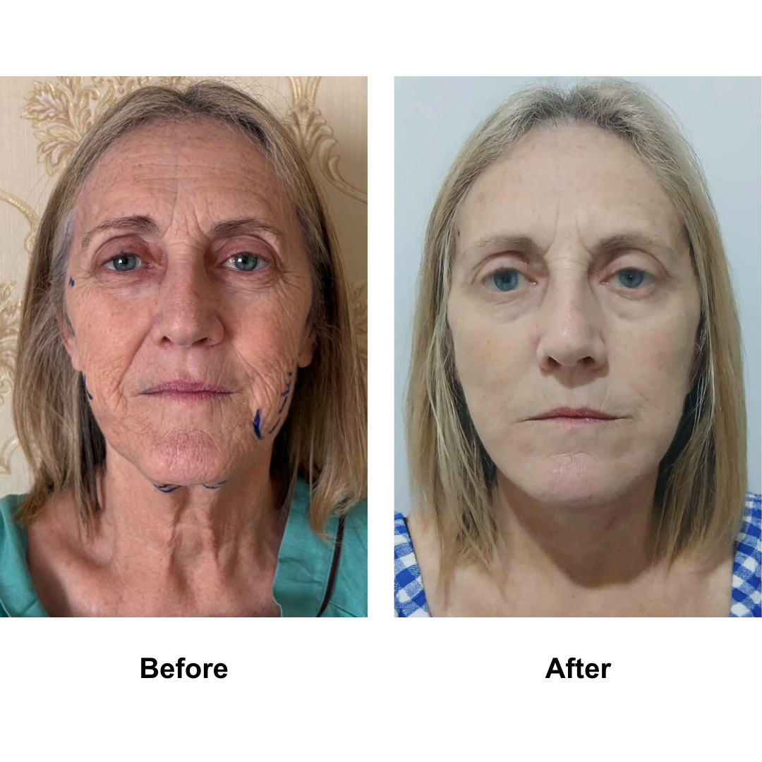 Julie had FFNL + Platysmaplasty with Dr. Ring-1