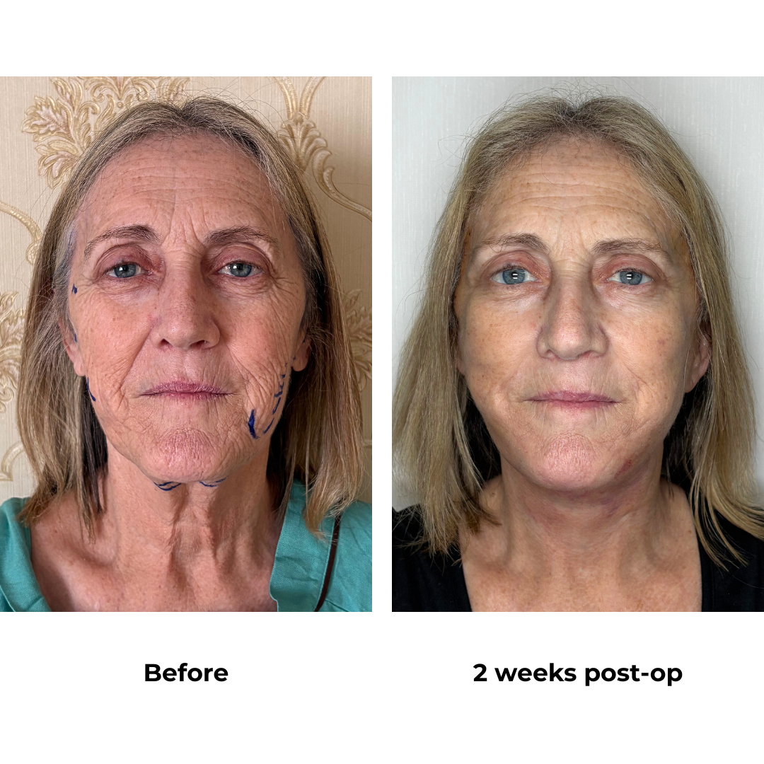 Julie had FFNL + Platysmaplasty with Dr. Ring