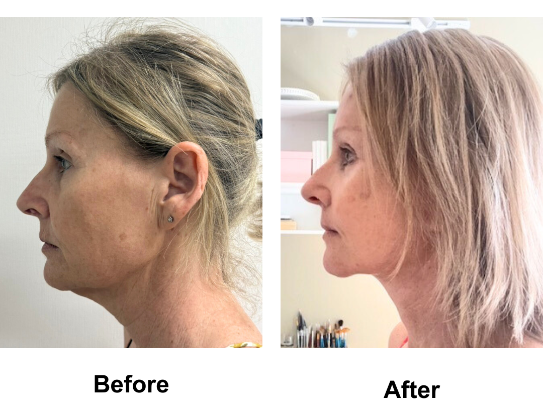 Julie had MFNL+ Chin lift + LB + Endoscopic brow lift wit Dr. Ring (2)