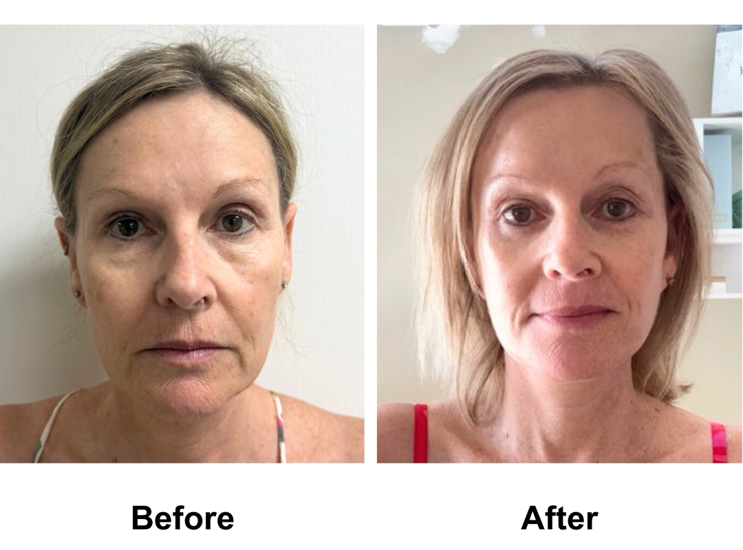 Julie had MFNL+ Chin lift + LB + Endoscopic brow lift wit Dr. Ring