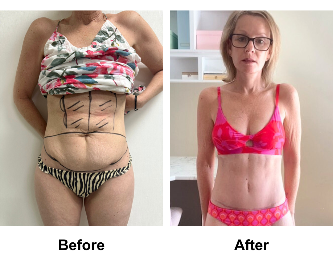 Julie had Standard TT + VASER lipo on upper abs with Dr. Ring