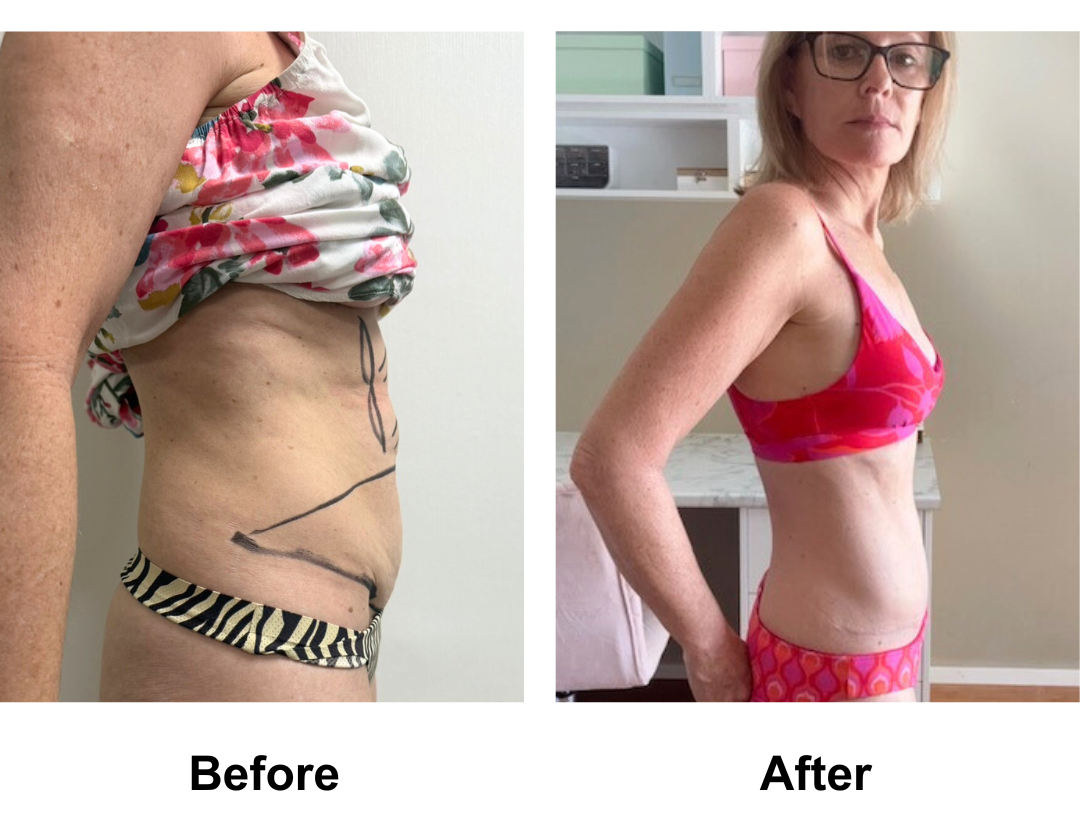 Julie had Standard TT + lipo on upper abs with Dr. Ring