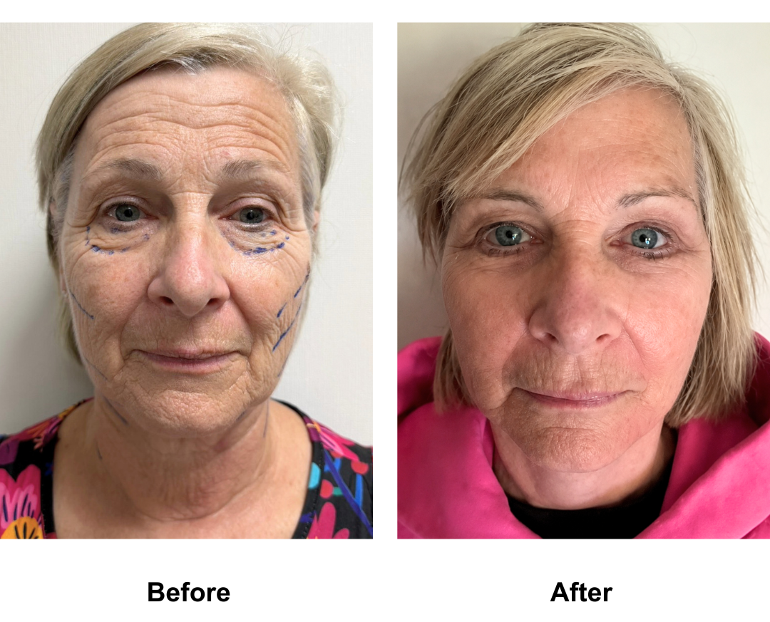 Julie, 61 had FFNL + LB with Dr. Ring (2)