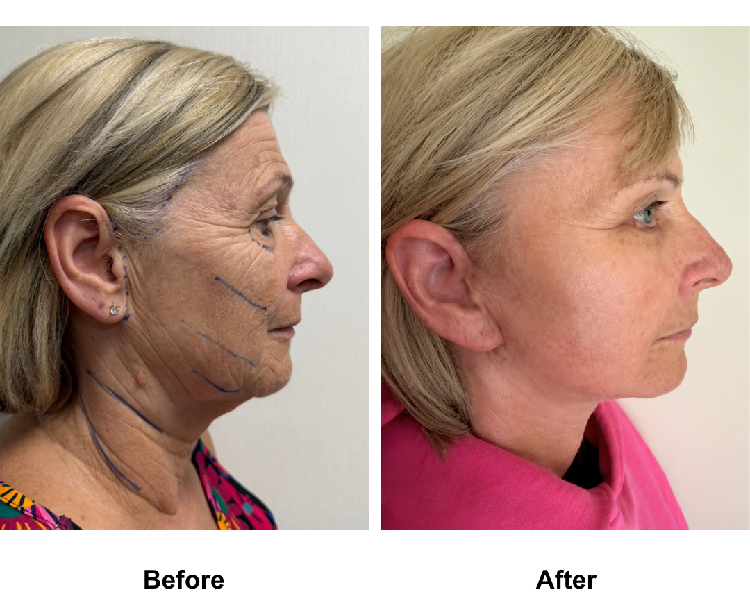 Julie, 61 had FFNL + LB with Dr. Ring (3)