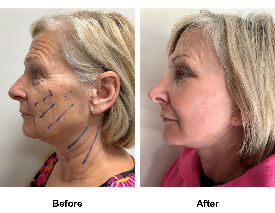 Julie, 61 had FFNL + LB with Dr. Ring