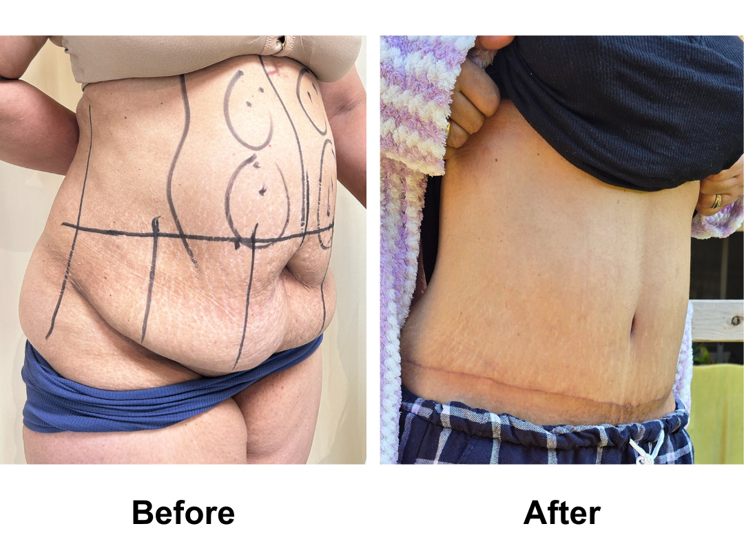 Julieana had ExTT + VASER lipo 1 area on upper abs with Dr. Jatuporn