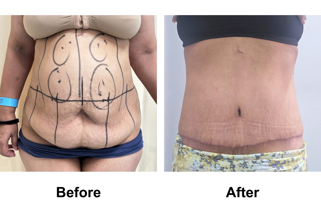 Julieana had MFNL + Lipo cheek and chin + ExTT + Lipo on upper ab with Dr. Jatuporn