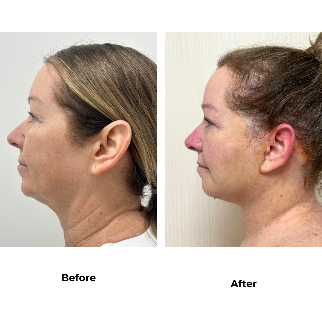 Justine had MFNL, chin lift with Dr. Jatuporn (2)