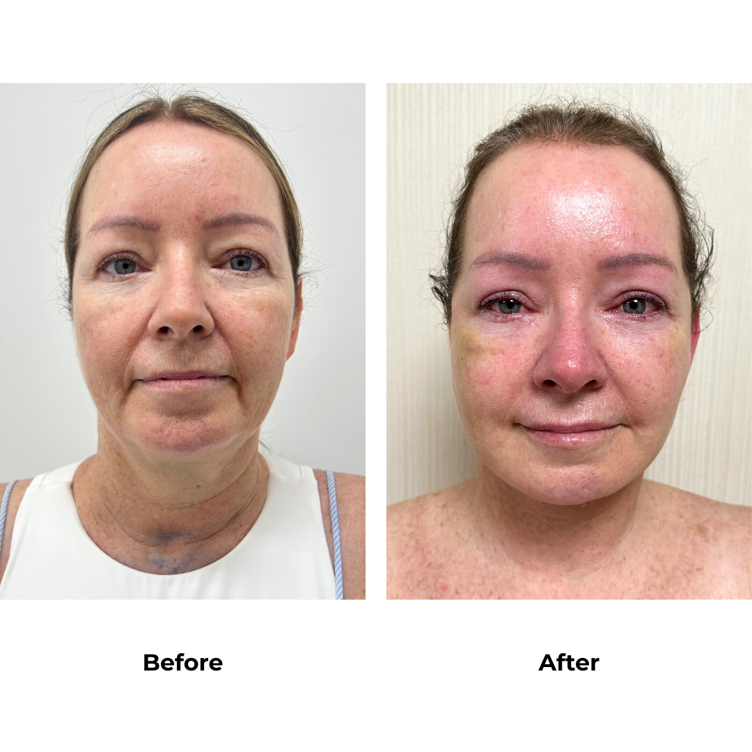 Justine had MFNL, chin lift with Dr. Jatuporn