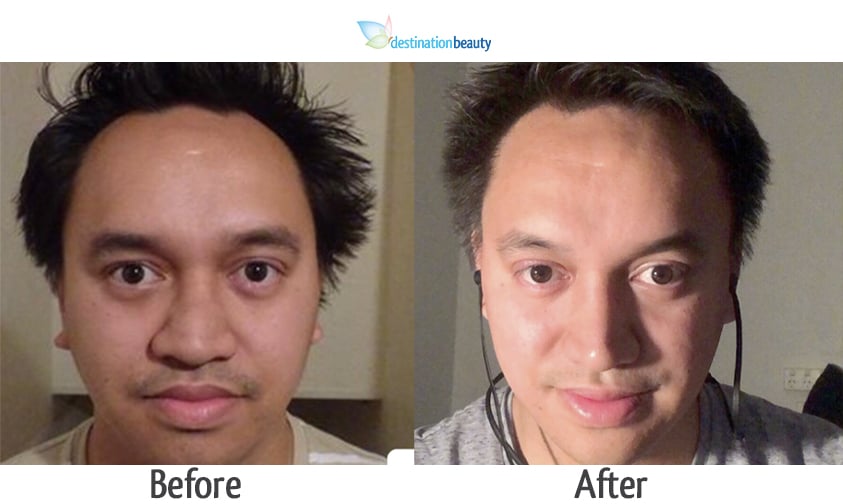 Nose Job Thailand See Corey's amazing result!