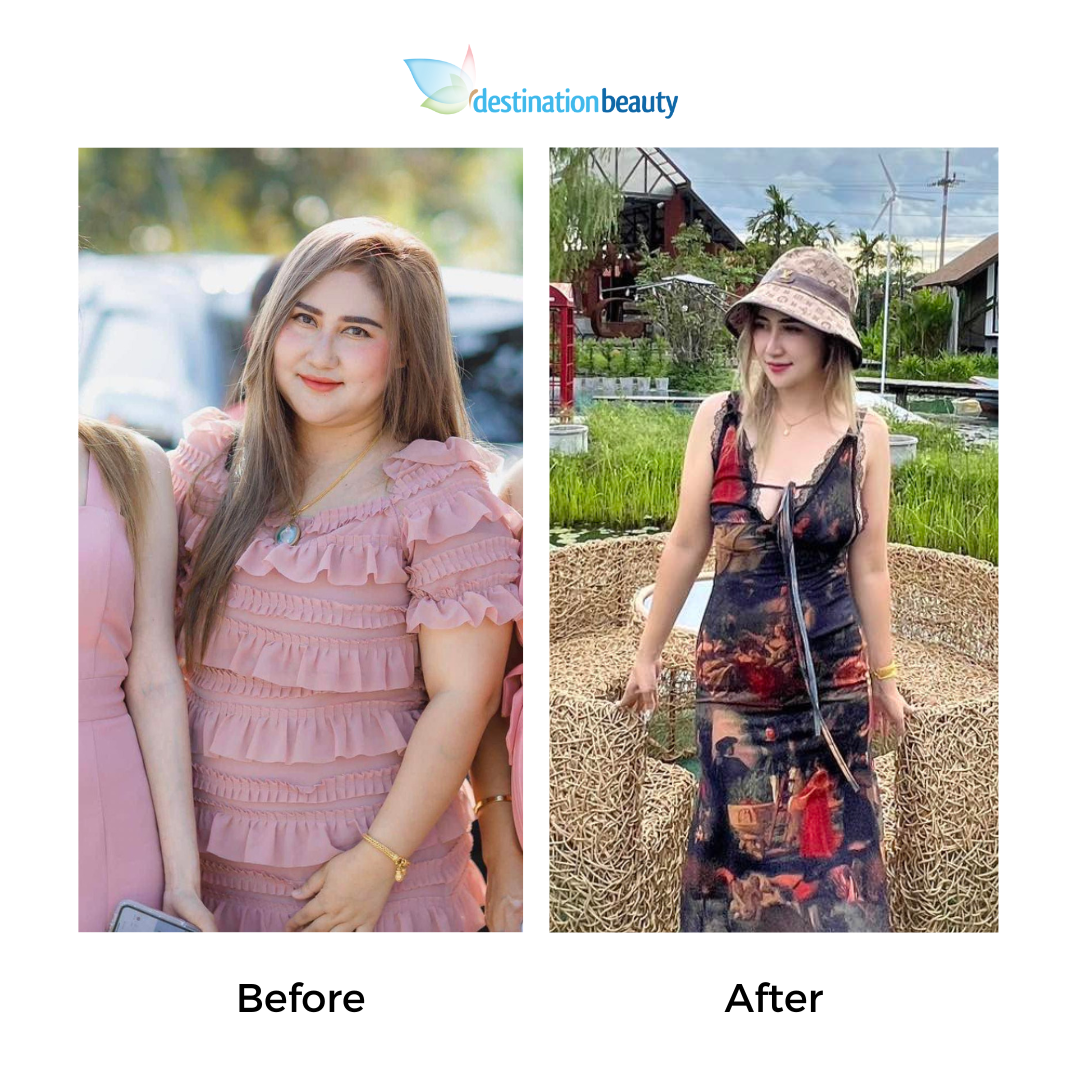 Kamolmat had gastric sleeve