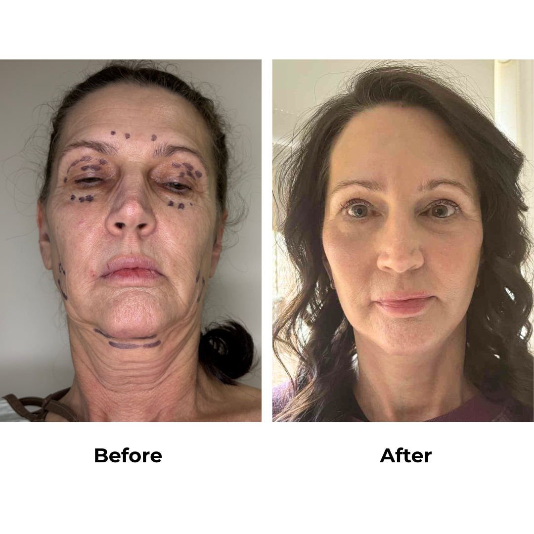 Karen had FFNL + LB with Dr.Ring