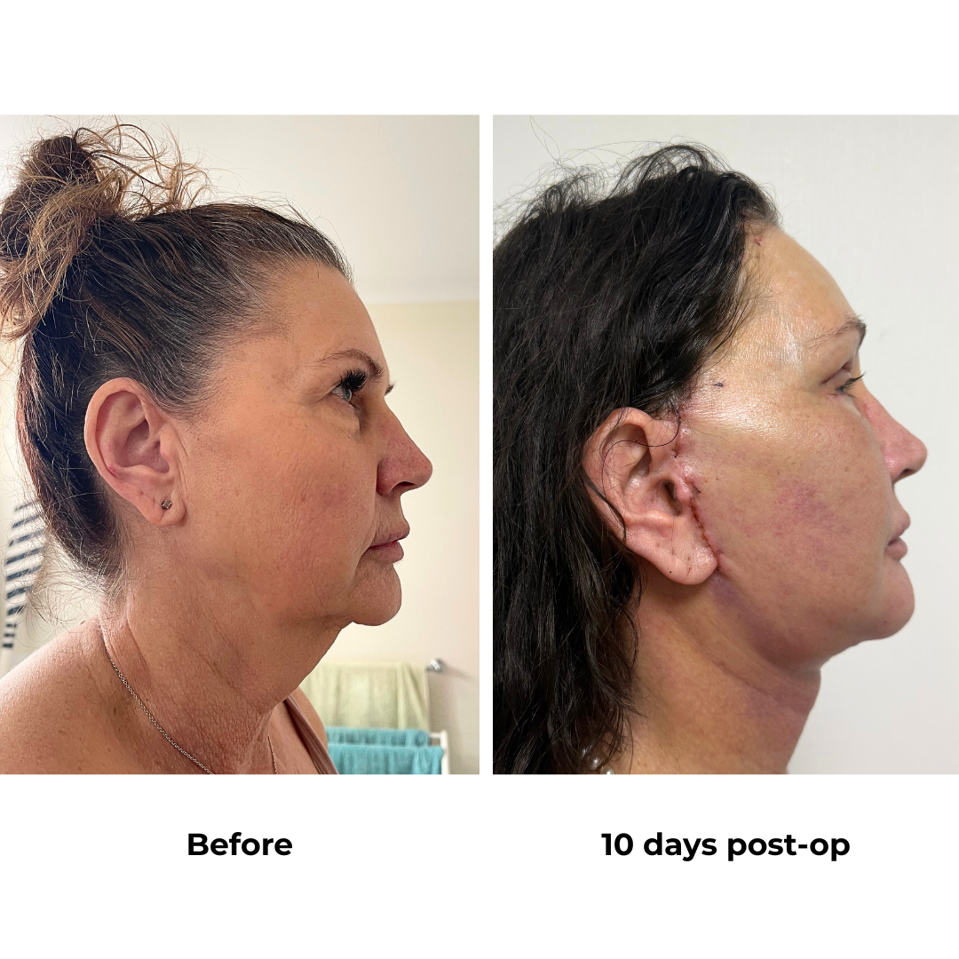 Karen had MFNL + UB  + LB + Chin lift + Endoscopic forehead lift with Dr. Ring (1)