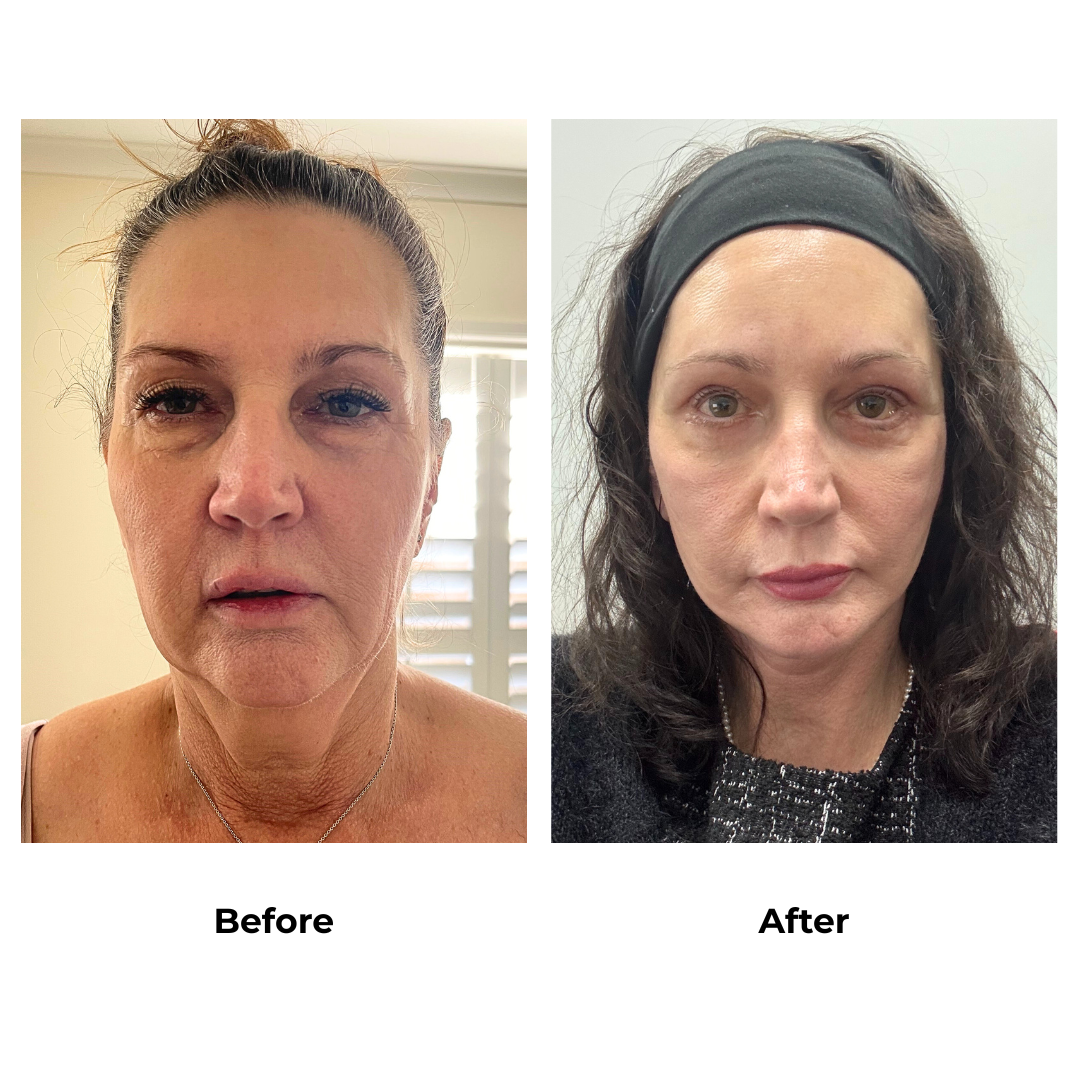 Karen had MFNL + UB  + LB + Chin lift + Endoscopic forehead lift with Dr. Ring (2)