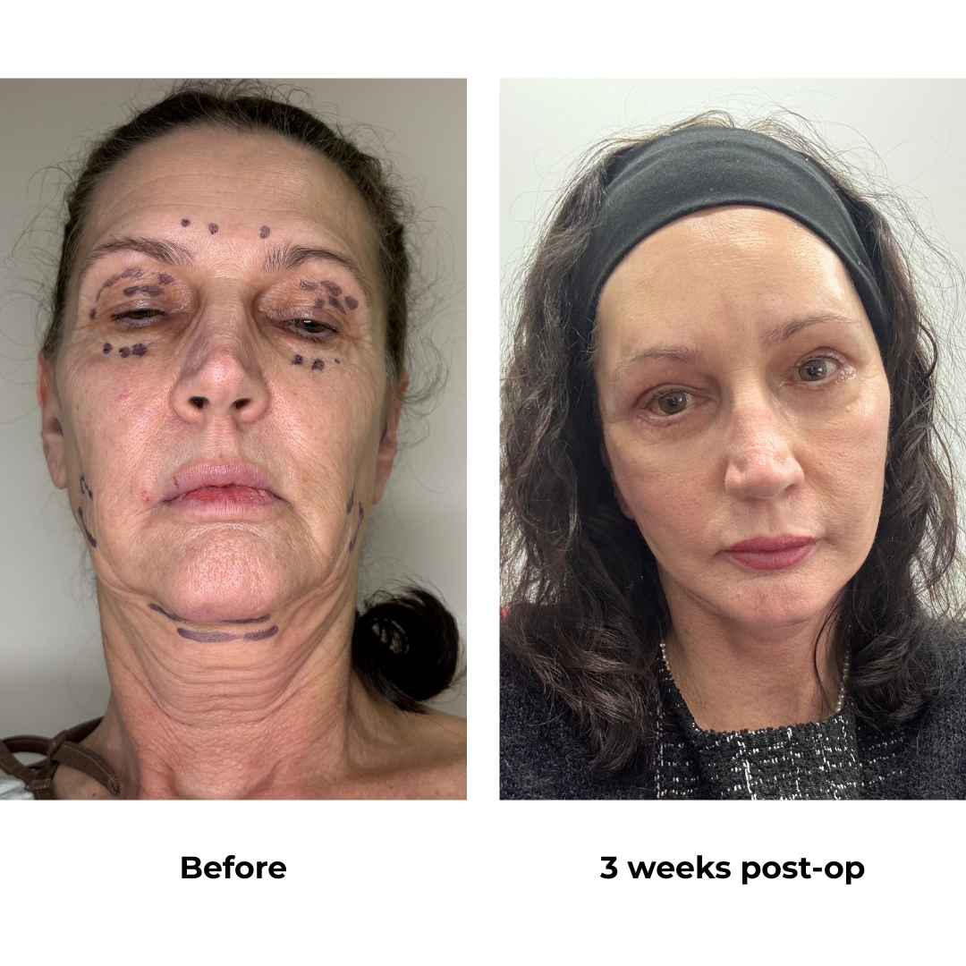 Karen had MFNL + UB + LB + Chin lift + Endoscopic forehead lift with Dr. Ring
