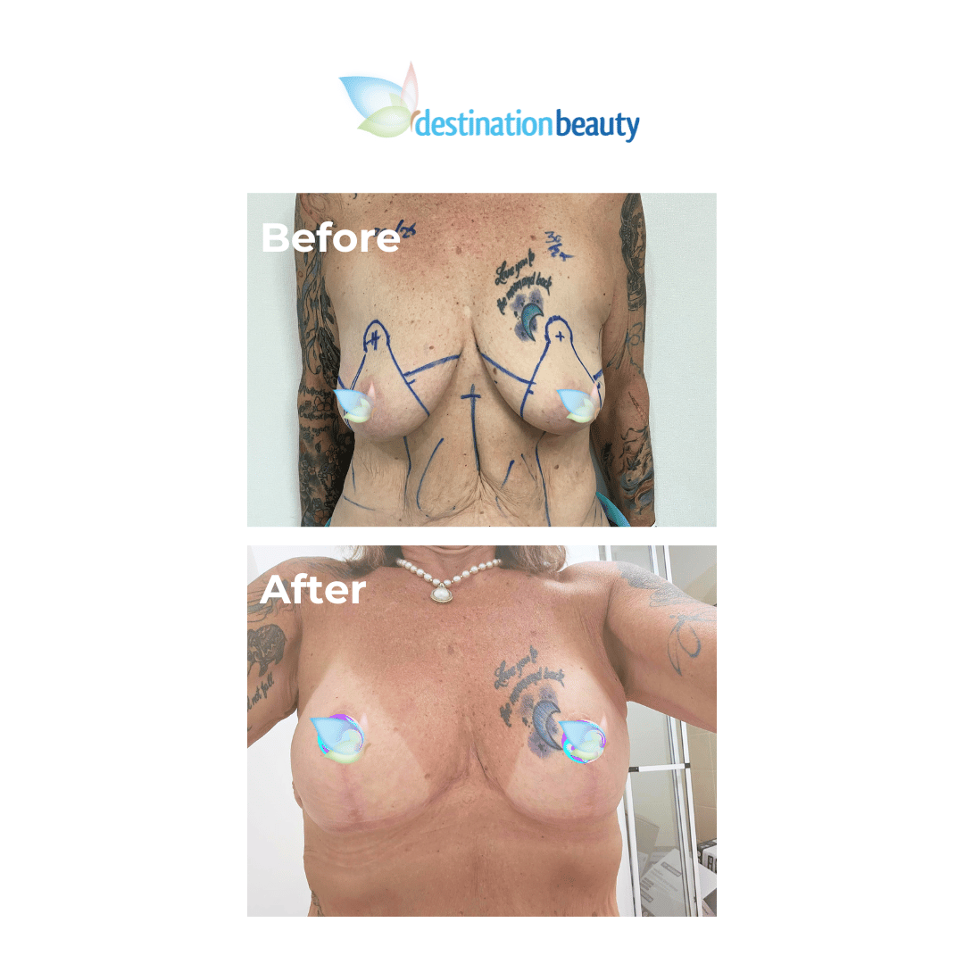 Karen skin removal surgery in Thailand (2)
