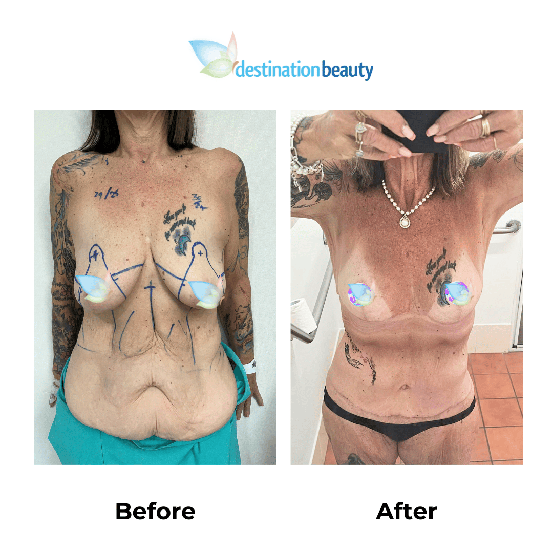 Karen skin removal surgery in Thailand (3)