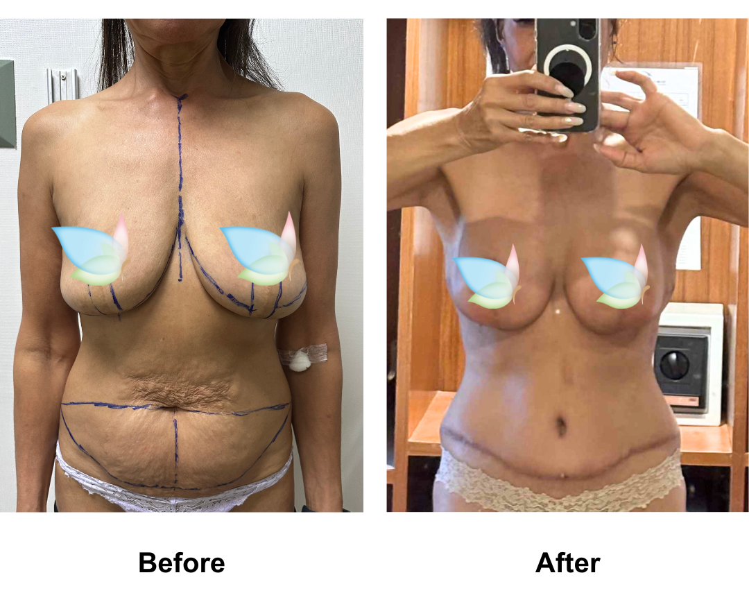 Karlean had Rev. BABL (225 M+) + Ex TT with Dr. Weerachai (1)