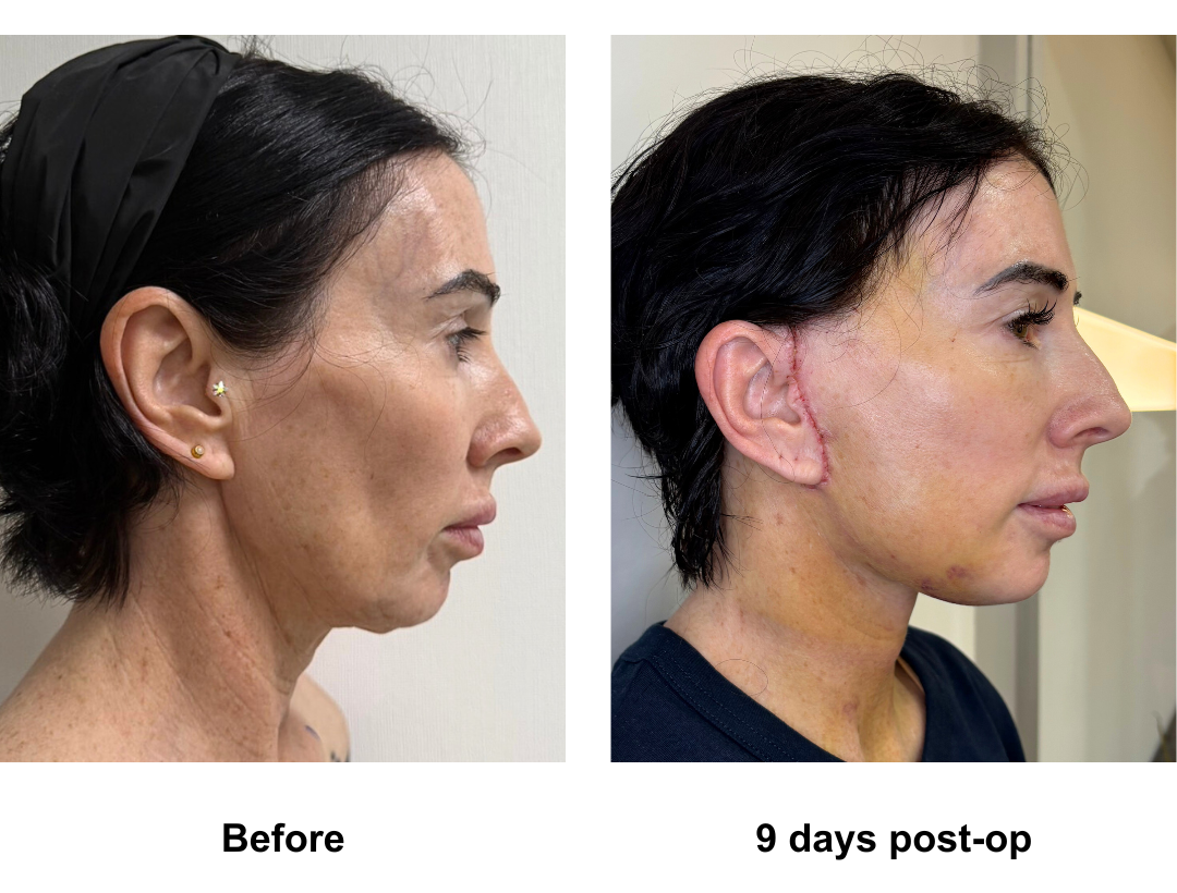 Karlene had MFNL with Dr. Ring (2)