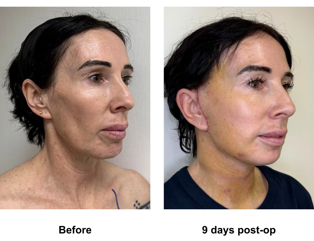 Karlene had MFNL with Dr. Ring (3)