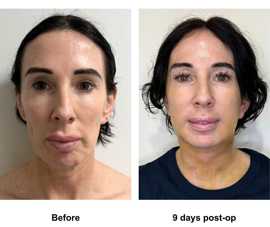 Karlene had MFNL with Dr. Ring-1