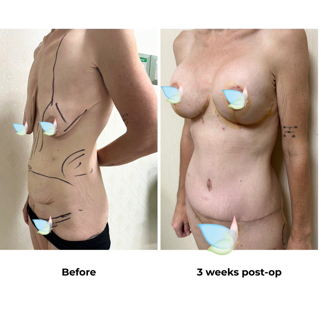 Karli had BABL + ExTT + ML + Lipo with Dr. Ring (2)