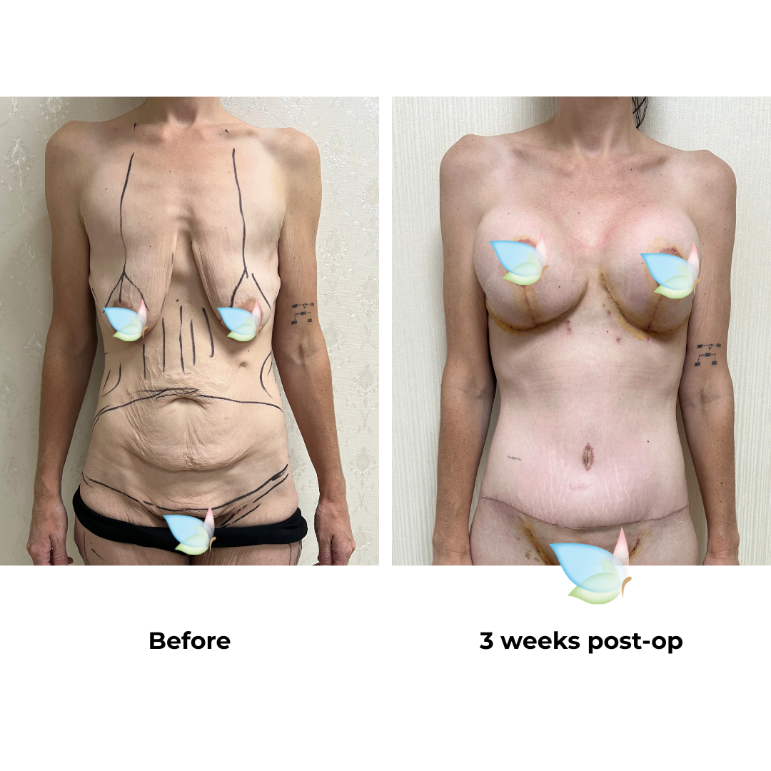 Karli had BABL + ExTT + ML + Lipo with Dr. Ring