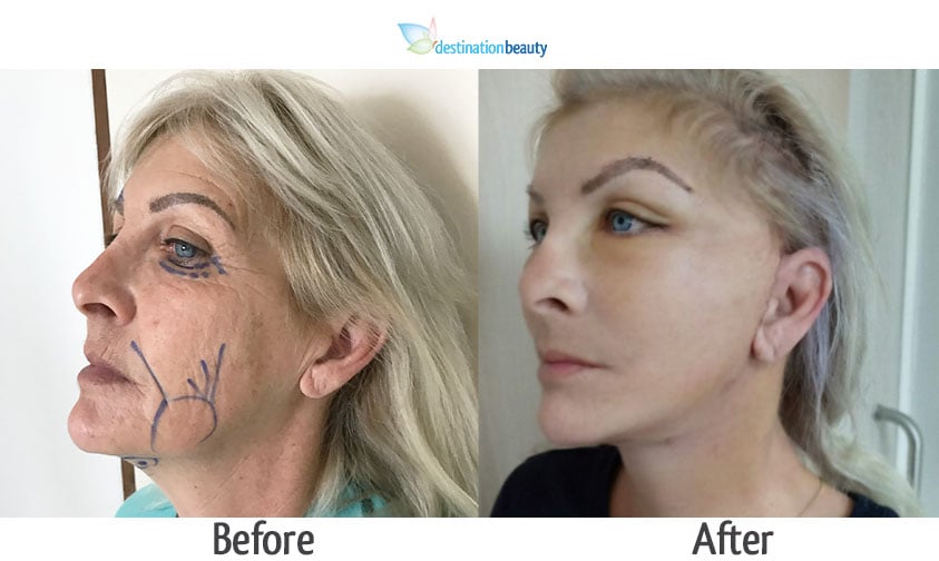 Face lift surgery in Thailand! See Kathleen's after pictures