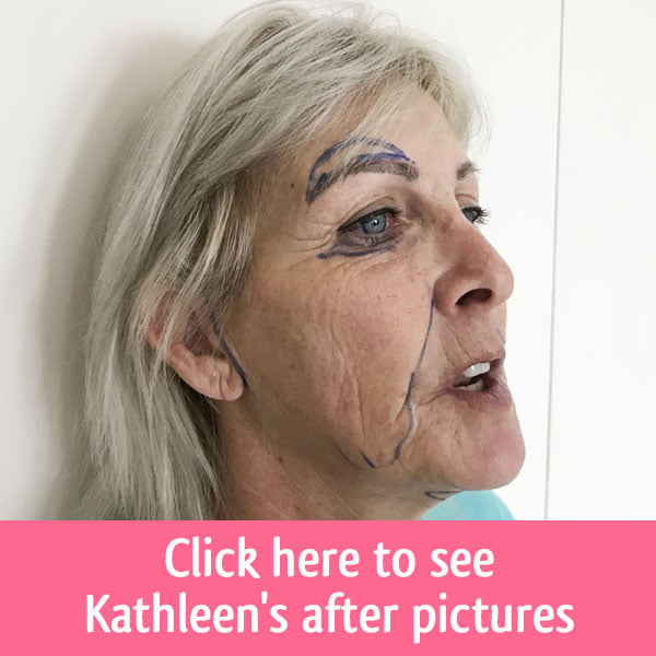 Kathleens before facelift surgery